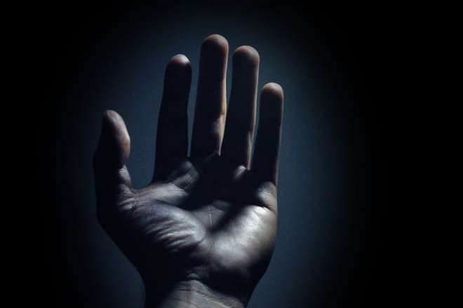 hiperhidrosis palmar