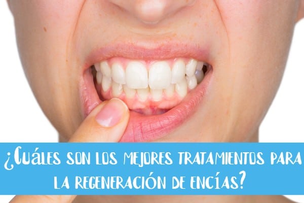 ¿Cuáles son los mejores tratamientos para la regeneración de encías?