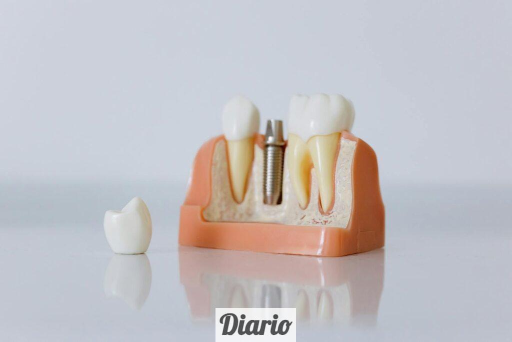 implantes dentales