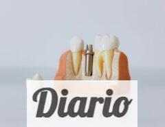 implantes dentales