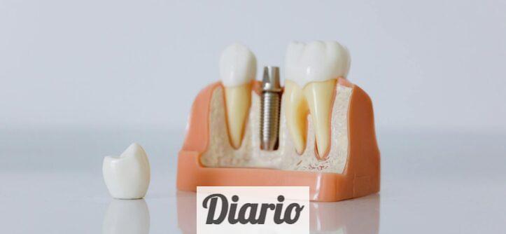 implantes dentales