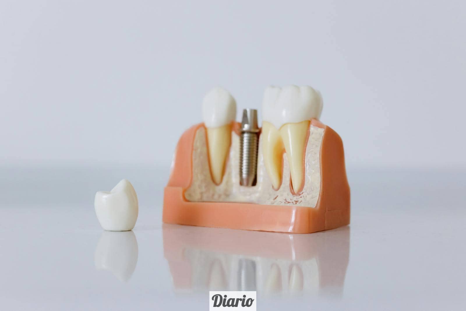 implantes dentales